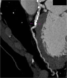 Diseased LAD - CTisus CT Scan