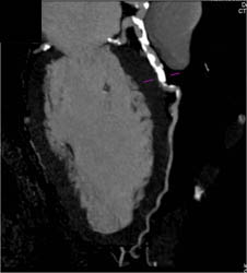 Diseased LAD - CTisus CT Scan