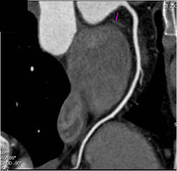 Normal LAD - CTisus CT Scan