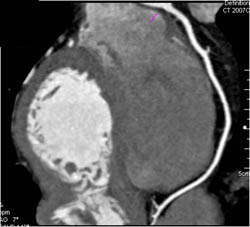 Normal LAD - CTisus CT Scan