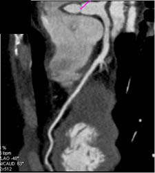 Normal LAD - CTisus CT Scan