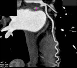 Normal LAD - CTisus CT Scan