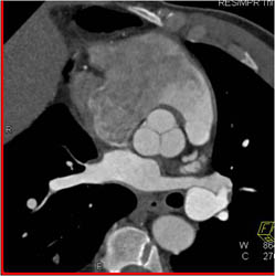 Normal Aortic Valve - CTisus CT Scan