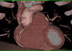 Prior Bypass Grafts in RCA Circulation - CTisus CT Scan