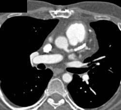 Diseased LAD - CTisus CT Scan