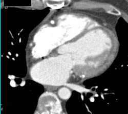 Diseased LAD - CTisus CT Scan