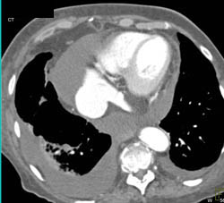 Pericardial Effusion - CTisus CT Scan