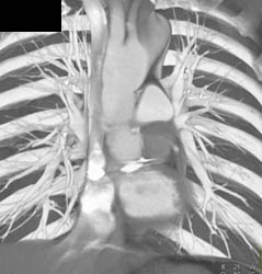 Partially Calcified Aortic Valve - CTisus CT Scan