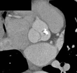 Diseased Leaflet Aortic Valve - CTisus CT Scan