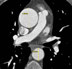 Dilated Root With Aortic Valve Replacement (AVR) - CTisus CT Scan