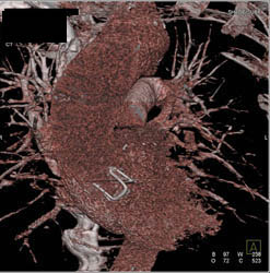 Valve Replacement With Leaflet Sparing Procedure - CTisus CT Scan