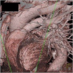 Normal LAD - CTisus CT Scan