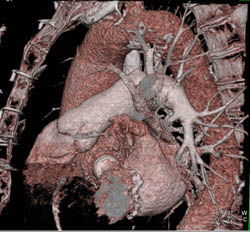 Diseased LAD - CTisus CT Scan