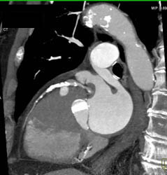 Diseased LAD - CTisus CT Scan