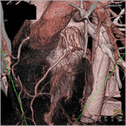 Diseased LAD - CTisus CT Scan