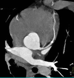 Diseased LAD - CTisus CT Scan