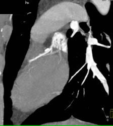 Diseased LAD - CTisus CT Scan