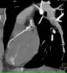 Diseased LAD - CTisus CT Scan