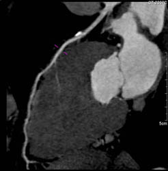 Diseased LAD - CTisus CT Scan