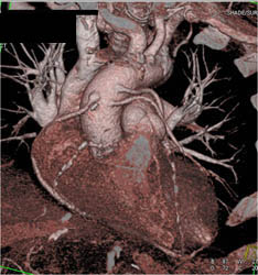 3 Patent Venous Grafts - CTisus CT Scan