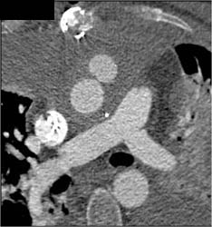 Pseudoaneurysm Off Ascending Aorta With Mediastinal Bleed - CTisus CT Scan