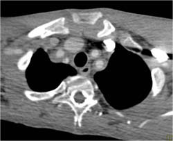 Takayasu's Arteritis - CTisus CT Scan