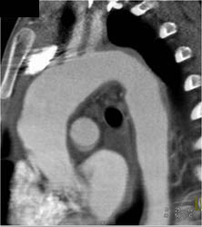 Takayasu's Arteritis - CTisus CT Scan