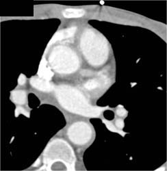 Takayasu's Arteritis - CTisus CT Scan