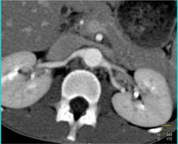 Takayasu's Arteritis - CTisus CT Scan