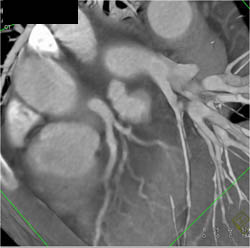 Coronary Artery Involvement By Takayasu's Arteritis - CTisus CT Scan