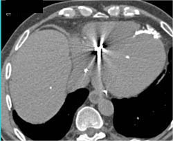 Prior Myocardial Infarct - CTisus CT Scan