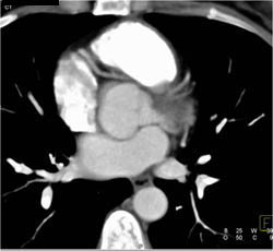 Right Coronary Artery Arises Off the Left Cusp - CTisus CT Scan