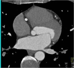 Beautiful Patent RCA Stent - CTisus CT Scan