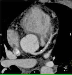 CCTA: LAD Disease - CTisus CT Scan