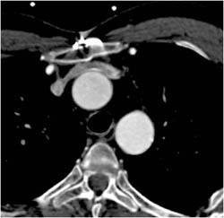 Prior Coarctation of the Aorta (COA) Repair - CTisus CT Scan