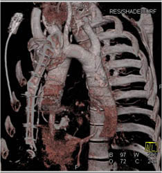 Dilated Internal Mammary Arteries in Patient With Coa - CTisus CT Scan