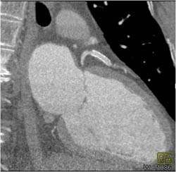 Patent LAD Stent - CTisus CT Scan