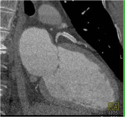 Patent LAD Stent - CTisus CT Scan