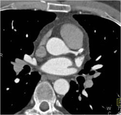 Patent LAD Stent - CTisus CT Scan