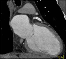 Patent LAD Stent - CTisus CT Scan