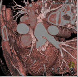 Stent in LAD - CTisus CT Scan