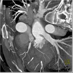 Stent in LAD - CTisus CT Scan