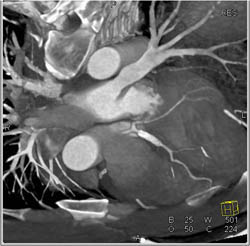 Stent in LAD - CTisus CT Scan