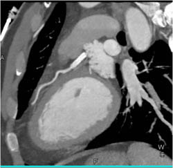 Stent in LAD - CTisus CT Scan