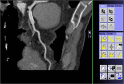 Stent in LAD - CTisus CT Scan