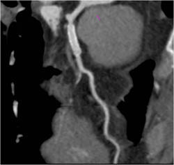 Stent in LAD - CTisus CT Scan