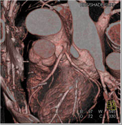 Patent LAD and Circumflex - CTisus CT Scan