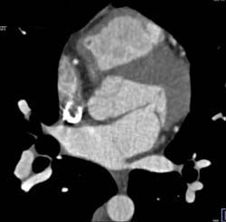 Cor Triatrium - CTisus CT Scan