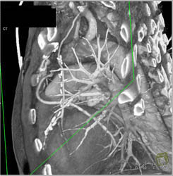 Patent Left Internal Mammary Artery (LIMA) and Venous Grafts - CTisus CT Scan