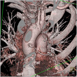 Saphenous Graft and Left Internal Mammary Artery (LIMA) Graft - CTisus CT Scan